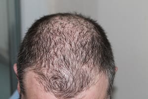 hair loss treatment